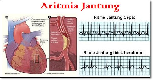 Aritmia-Jantung
